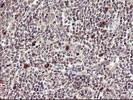 CDC123 Antibody - IHC of paraffin-embedded Human lymphoma tissue using anti-CDC123 mouse monoclonal antibody. (Heat-induced epitope retrieval by 10mM citric buffer, pH6.0, 120°C for 3min).