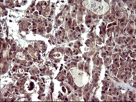 CDC123 Antibody - IHC of paraffin-embedded Carcinoma of Human thyroid tissue using anti-CDC123 mouse monoclonal antibody. (Heat-induced epitope retrieval by 10mM citric buffer, pH6.0, 120°C for 3min).