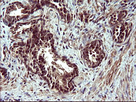CDC123 Antibody - IHC of paraffin-embedded Carcinoma of Human prostate tissue using anti-CDC123 mouse monoclonal antibody. (Heat-induced epitope retrieval by 10mM citric buffer, pH6.0, 120°C for 3min).