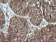 CDC123 Antibody - IHC of paraffin-embedded Adenocarcinoma of Human ovary tissue using anti-CDC123 mouse monoclonal antibody.