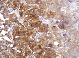 CDC123 Antibody - IHC of paraffin-embedded Adenocarcinoma of Human colon tissue using anti-${SYMBOL} mouse monoclonal antibody.
