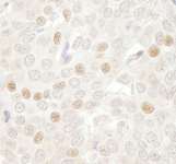 CDC20 Antibody - Detection of Human CDC20 by Immunohistochemistry. Sample: FFPE section of human breast carcinoma. Antibody: Affinity purified rabbit anti-CDC20 used at a dilution of 1:250.