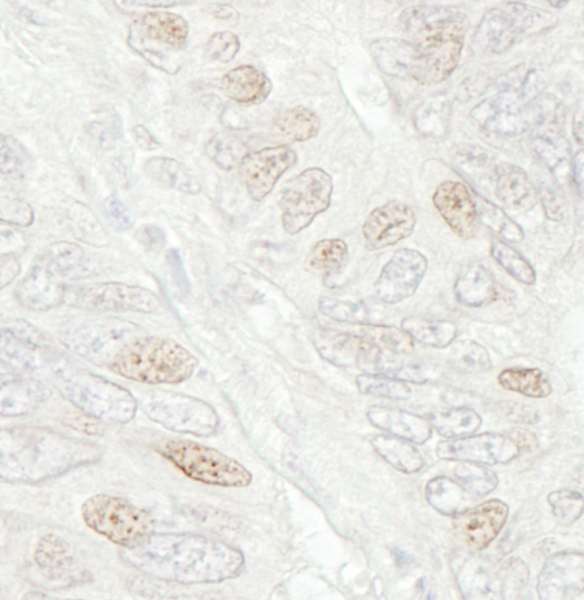 CDC20 Antibody - Detection of Human CDC20 by Immunohistochemistry. Sample: FFPE section of human colon carcinoma. Antibody: Affinity purified rabbit anti-CDC20 used at a dilution of 1:250.