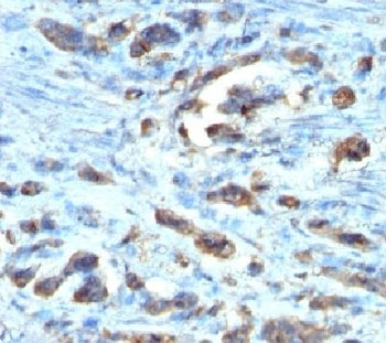 CDC20 Antibody - IHC testing of FFPE gastric carcinoma with Cdc20 antibody (clone AR12) This image was taken for the unmodified form of this product. Other forms have not been tested.