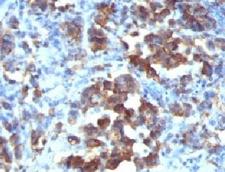 CDC20 Antibody - Formalin-fixed, paraffin-embedded human gastric carcinoma stained with Cdc20 antibody (CDC20/1102).  This image was taken for the unmodified form of this product. Other forms have not been tested.