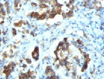 CDC20 Antibody - IHC testing of FFPE human gastric carcinoma with Cdc20 antibody (clone CLDC20-1).  This image was taken for the unmodified form of this product. Other forms have not been tested.