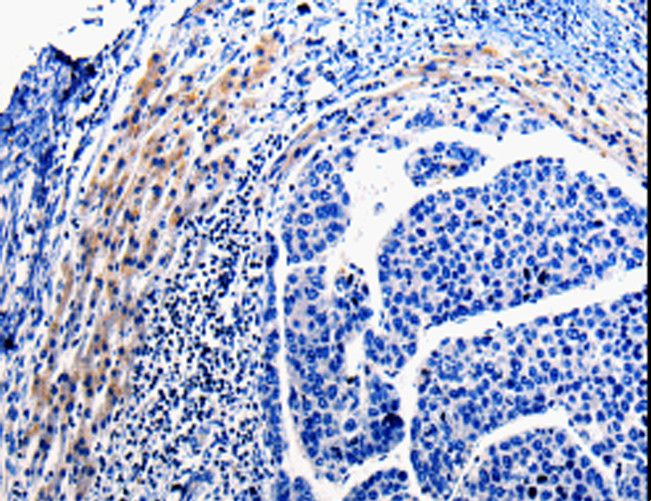 CDC20 Antibody - Immunohistochemistry of paraffin-embedded Human liver cancer using CDC20 Polyclonal Antibody at dilution of 1:10.