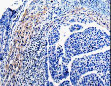 CDC20 Antibody - Immunohistochemistry of paraffin-embedded Human liver cancer using CDC20 Polyclonal Antibody at dilution of 1:10.