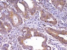 CDC20 Antibody - IHC testing of FFPE human colon cancer tissue with Cdc20 antibody at 1ug/ml. Required HIER: steam section in pH6 citrate buffer for 20 min and allow to cool prior to testing.