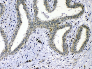 CDC20 Antibody - IHC testing of FFPE human breast cancer tissue with Cdc20 antibody at 1ug/ml. Required HIER: steam section in pH6 citrate buffer for 20 min and allow to cool prior to testing.