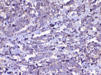 CDC20 Antibody - IHC testing of FFPE human lung cancer tissue with Cdc20 antibody at 1ug/ml. Required HIER: steam section in pH6 citrate buffer for 20 min and allow to cool prior to testing.