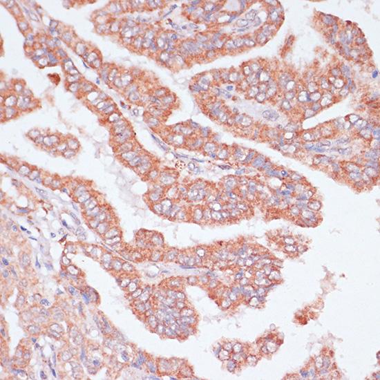 CDC20 Antibody - Immunohistochemistry of paraffin-embedded Human thyroid cancer using CDC20 Polyclonal Antibody at dilution of 1:100 (40x lens).