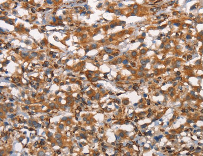 CDC23 Antibody - Immunohistochemistry of paraffin-embedded Human thyroid cancer using CDC23 Polyclonal Antibody at dilution of 1:50.