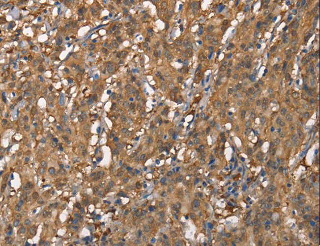 CDC25A Antibody - Immunohistochemistry of paraffin-embedded Human gastric cancer using CDC25A Polyclonal Antibody at dilution of 1:60.