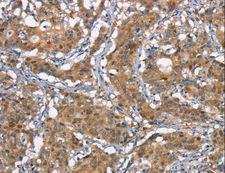 CDC25A Antibody - Immunohistochemistry of paraffin-embedded Human gastric cancer using CDC25A Polyclonal Antibody at dilution of 1:50.