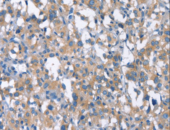 CDC25A Antibody - Immunohistochemistry of paraffin-embedded Human thyroid cancer using CDC25A Polyclonal Antibody at dilution of 1:50.