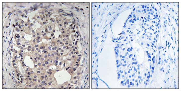 CDC25A Antibody - Immunohistochemistry analysis of paraffin-embedded human breast carcinoma, using CDC25A (Phospho-Ser178) Antibody. The picture on the right is blocked with the phospho peptide.