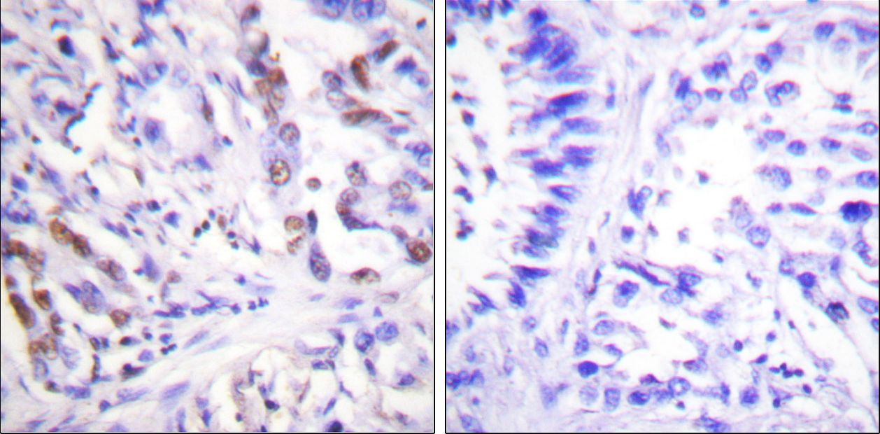 CDC25A Antibody - Immunohistochemistry of paraffin-embedded human lung carcinoma using CDC25A (Phospho-Ser75) Antibody.