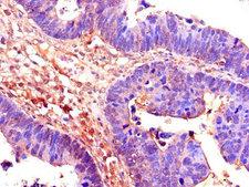 CDC25B Antibody - Immunohistochemistry of paraffin-embedded human ovarian cancer using CDC25B Antibody at dilution of 1:100