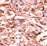 CDC25B Antibody - Formalin-fixed and paraffin-embedded human cancer tissue reacted with the primary antibody, which was peroxidase-conjugated to the secondary antibody, followed by AEC staining. This data demonstrates the use of this antibody for immunohistochemistry; clinical relevance has not been evaluated. BC = breast carcinoma; HC = hepatocarcinoma.