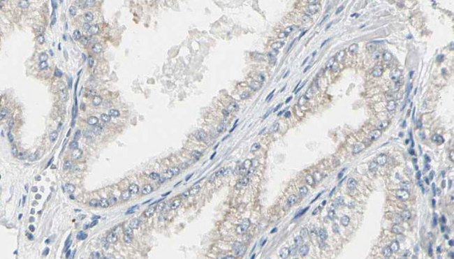 CDC25B Antibody - 1:100 staining human prostate tissue by IHC-P. The sample was formaldehyde fixed and a heat mediated antigen retrieval step in citrate buffer was performed. The sample was then blocked and incubated with the antibody for 1.5 hours at 22°C. An HRP conjugated goat anti-rabbit antibody was used as the secondary.