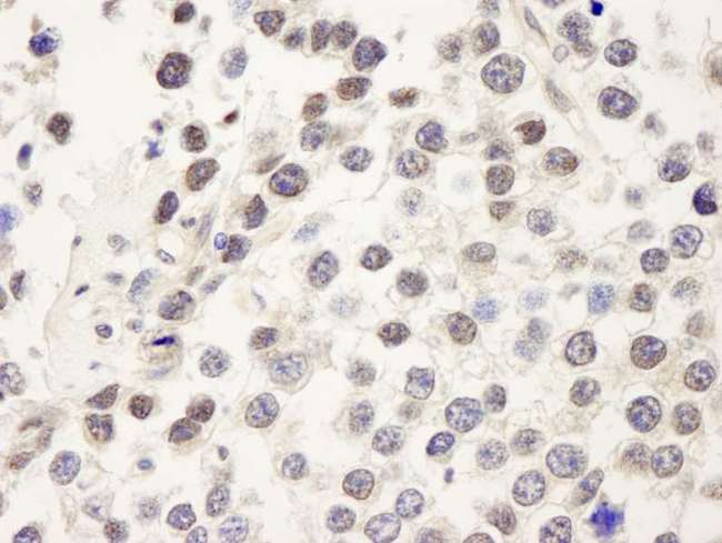CDC25C Antibody - Detection of Human CDC25c by Immunohistochemistry. Sample: FFPE section of human seminoma. Antibody: Affinity purified rabbit anti-CDC25c used at a dilution of 1:250.