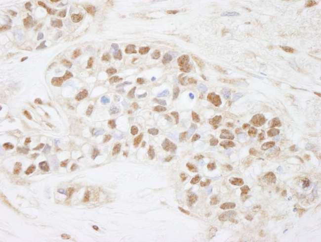 CDC25C Antibody - Detection of Human CDC25c by Immunohistochemistry. Sample: FFPE section of human breast carcinoma. Antibody: Affinity purified rabbit anti-CDC25c used at a dilution of 1:250.
