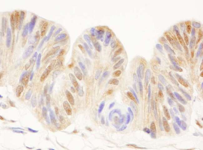 CDC25C Antibody - Detection of Human CDC25c by Immunohistochemistry. Sample: FFPE section of human ovarian carcinoma. Antibody: Affinity purified rabbit anti-CDC25c used at a dilution of 1:1000 (1 ug/ml).