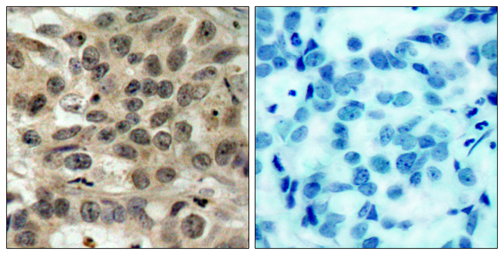 CDC25C Antibody - Immunohistochemistry analysis of paraffin-embedded human breast carcinoma tissue, using CDC25C Antibody. The picture on the right is blocked with the synthesized peptide.