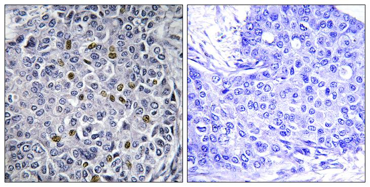 CDC25C Antibody - Peptide - + Immunohistochemistry analysis of paraffin-embedded human breast carcinoma tissue using CDC25C antibody.