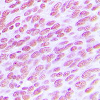 CDC25C Antibody - Immunohistochemical analysis of CDC25C staining in human breast cancer formalin fixed paraffin embedded tissue section. The section was pre-treated using heat mediated antigen retrieval with sodium citrate buffer (pH 6.0). The section was then incubated with the antibody at room temperature and detected using an HRP conjugated compact polymer system. DAB was used as the chromogen. The section was then counterstained with hematoxylin and mounted with DPX.