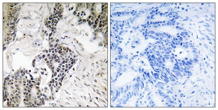 CDC25C Antibody - Immunohistochemistry analysis of paraffin-embedded human colon carcinoma, using CDC25C (Phospho-Ser198) Antibody. The picture on the right is blocked with the phospho peptide.