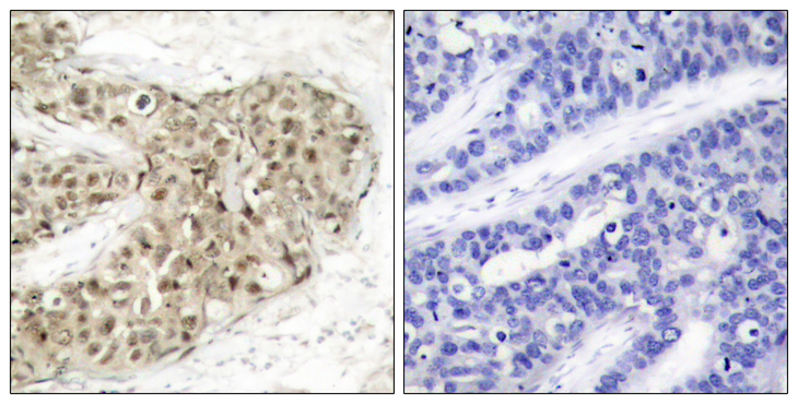 CDC25C Antibody - Immunohistochemistry analysis of paraffin-embedded human breast carcinoma, using CDC25C (Phospho-Ser216) Antibody. The picture on the right is blocked with the phospho peptide.