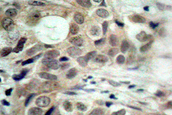 CDC25C Antibody - IHC of p-CDC25C (S216) pAb in paraffin-embedded human breast carcinoma tissue.
