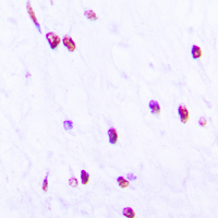CDC25C Antibody - Immunohistochemical analysis of CDC25C (pS216) staining in human lung cancer formalin fixed paraffin embedded tissue section. The section was pre-treated using heat mediated antigen retrieval with sodium citrate buffer (pH 6.0). The section was then incubated with the antibody at room temperature and detected using an HRP-conjugated compact polymer system. DAB was used as the chromogen. The section was then counterstained with hematoxylin and mounted with DPX.