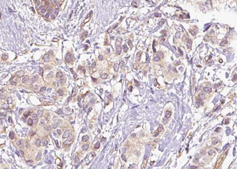 CDC25C Antibody - 1:100 staining human breast carcinoma tissue by IHC-P. The tissue was formaldehyde fixed and a heat mediated antigen retrieval step in citrate buffer was performed. The tissue was then blocked and incubated with the antibody for 1.5 hours at 22°C. An HRP conjugated goat anti-rabbit antibody was used as the secondary.