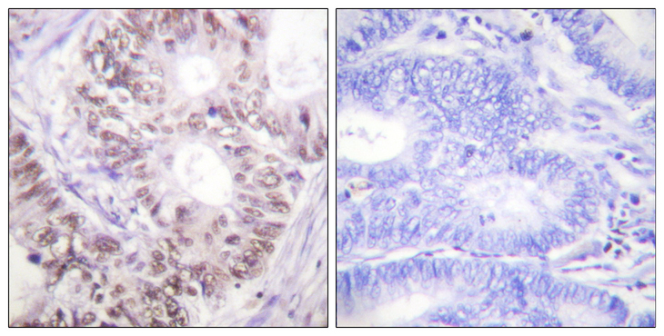 CDC25C Antibody - Immunohistochemistry analysis of paraffin-embedded human colon carcinoma, using CDC25C (Phospho-Thr48) Antibody. The picture on the right is blocked with the phospho peptide.
