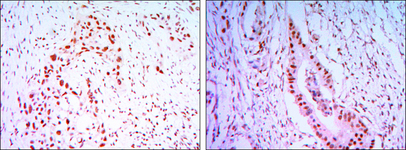 CDC27 Antibody - IHC of paraffin-embedded lung cancer tissues (left) and colon cancer tissues (right) using CDC27 mouse monoclonal antibody with DAB staining.