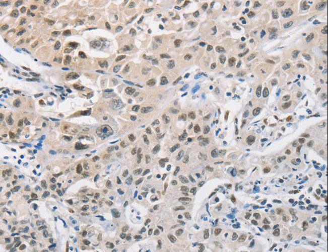 CDC27 Antibody - Immunohistochemistry of paraffin-embedded Human cervical cancer using CDC27 Polyclonal Antibody at dilution of 1:50.