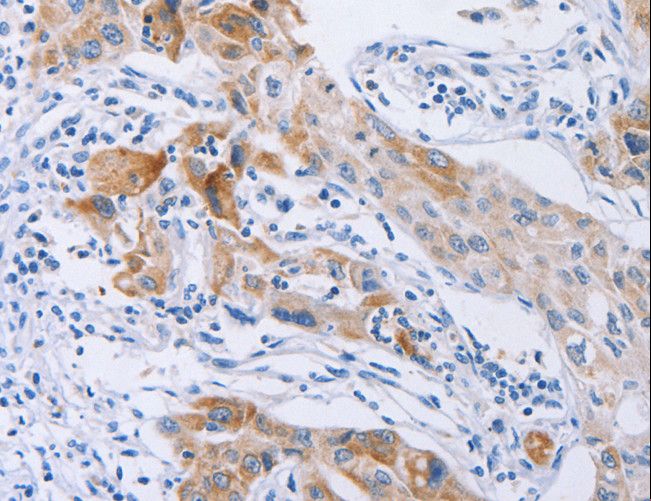 CDC27 Antibody - Immunohistochemistry of paraffin-embedded Human lung cancer using CDC27 Polyclonal Antibody at dilution of 1:40.