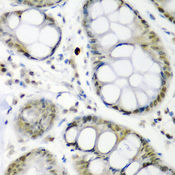 CDC27 Antibody - Immunohistochemistry of paraffin-embedded human colon carcinoma using CDC27 antibody at dilution of 1:200 (40x lens).