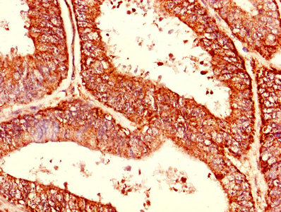 CDC34 Antibody - Immunohistochemistry of paraffin-embedded human endometrial cancer using CDC34 Antibody at dilution of 1:100