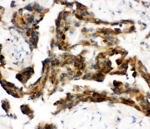 CDC37 Antibody - CDC37 antibody. IHC(P): Human Lung Cancer Tissue.