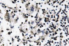 CDC37 Antibody - IHC of Catenin- (G650) pAb in paraffin-embedded human breast carcinoma tissue.