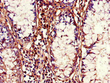 CDC37 Antibody - Immunohistochemistry of paraffin-embedded human colon cancer using CDC37 Antibody at dilution of 1:100