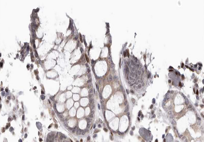 CDC37 Antibody - 1:200 staining human colon carcinoma tissue by IHC-P. The tissue was formaldehyde fixed and a heat mediated antigen retrieval step in citrate buffer was performed. The tissue was then blocked and incubated with the antibody for 1.5 hours at 22°C. An HRP conjugated goat anti-rabbit antibody was used as the secondary.