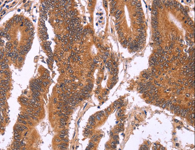 CDC37L1 Antibody - Immunohistochemistry of paraffin-embedded Human colon cancer using CDC37L1 Polyclonal Antibody at dilution of 1:60.