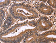 CDC37L1 Antibody - Immunohistochemistry of paraffin-embedded Human cervical cancer using CDC37L1 Polyclonal Antibody at dilution of 1:50.