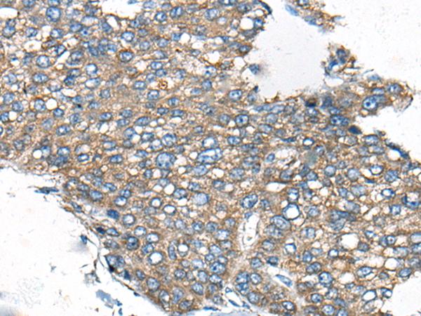 CDC42BPA / MRCK Antibody - Immunohistochemistry of paraffin-embedded Human liver cancer tissue  using CDC42BPA Polyclonal Antibody at dilution of 1:60(×200)
