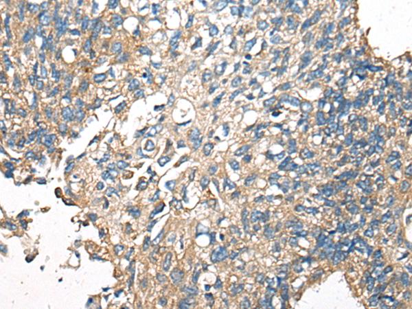 CDC42BPA / MRCK Antibody - Immunohistochemistry of paraffin-embedded Human lung cancer tissue  using CDC42BPA Polyclonal Antibody at dilution of 1:60(×200)